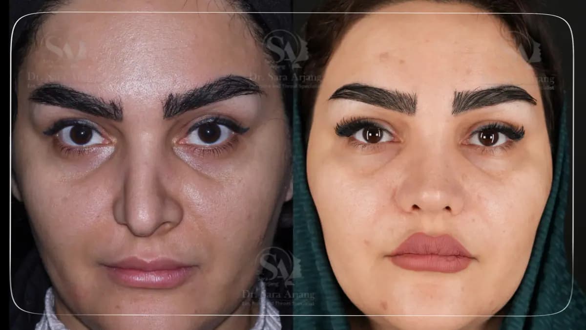 مريض لدى د. سارا أرجانج قبل عملية تجميل الأنف وبعدها، من الأمام.