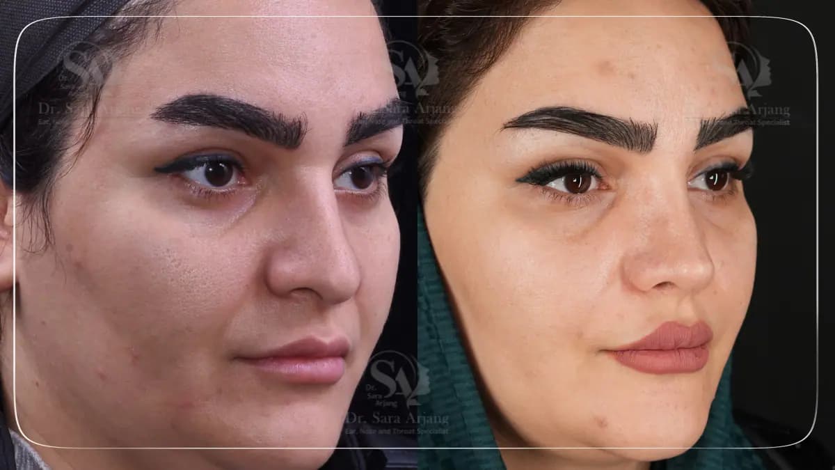 مريض لدى د. سارا أرجانج قبل عملية تجميل الأنف وبعدها، من الأمام.