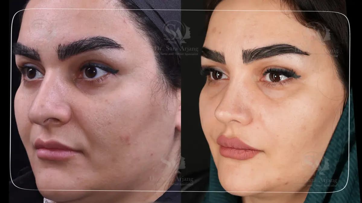 مريض لدى د. سارا أرجانج قبل عملية تجميل الأنف وبعدها، بزاوية ثلاثة أرباع.