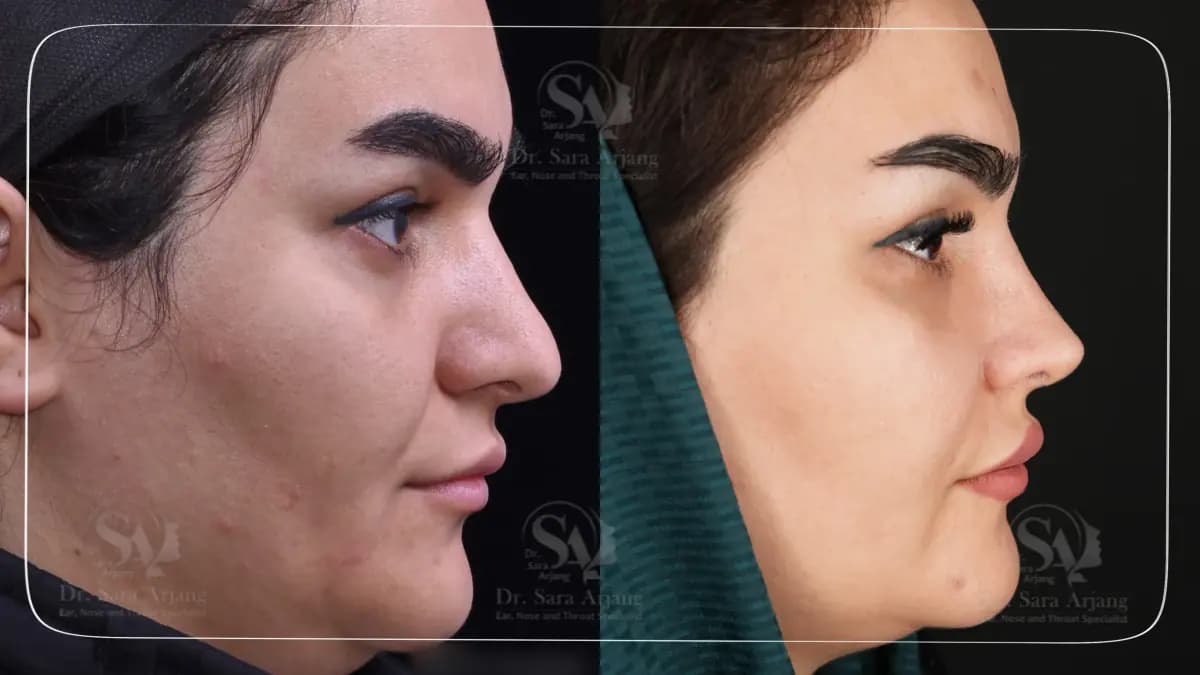 مريض لدى د. سارا أرجانج قبل عملية تجميل الأنف وبعدها، من الجانب.