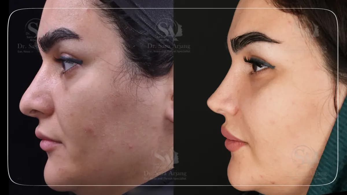 مريض لدى د. سارا أرجانج قبل عملية تجميل الأنف وبعدها، من الجانب.