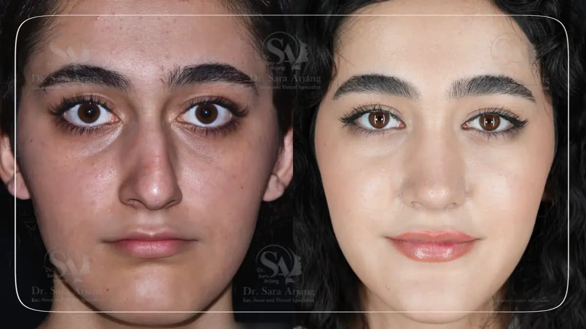 مريض لدى د. سارا أرجانج قبل عملية تجميل الأنف وبعدها، من الأمام.