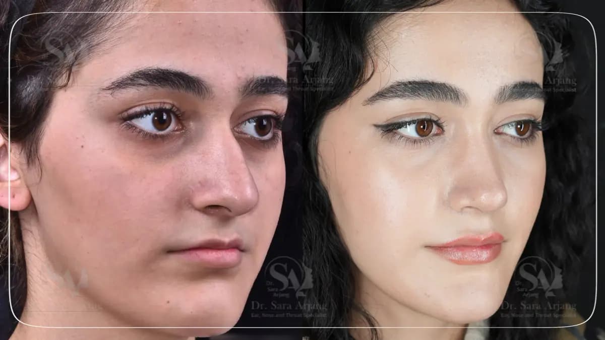 مريض لدى د. سارا أرجانج قبل عملية تجميل الأنف وبعدها، بزاوية ثلاثة أرباع.