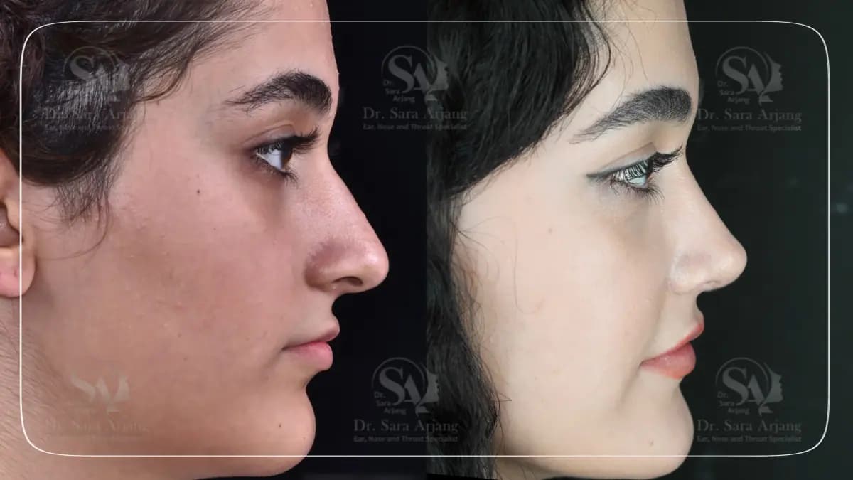 مريض لدى د. سارا أرجانج قبل عملية تجميل الأنف وبعدها، من الجانب.