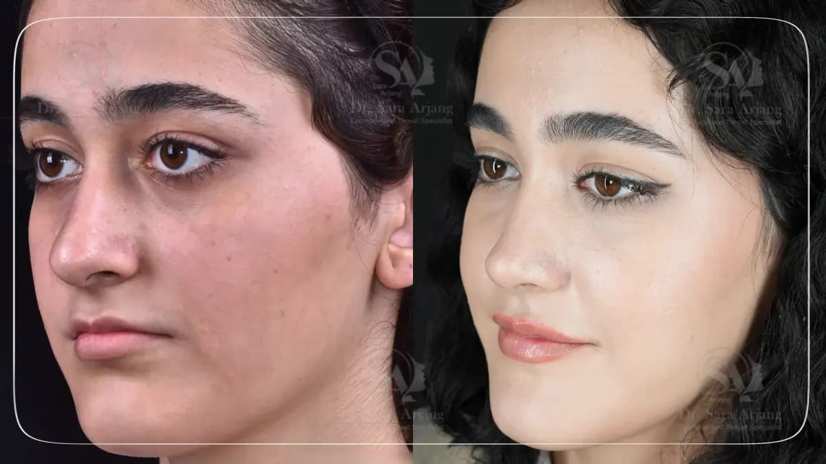 مريض لدى د. سارا أرجانج قبل عملية تجميل الأنف وبعدها، بزاوية ثلاثة أرباع.