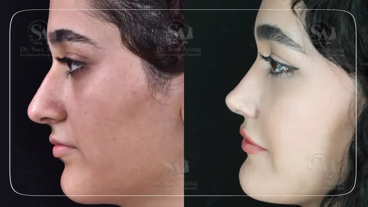 مريض لدى د. سارا أرجانج قبل عملية تجميل الأنف وبعدها، من الجانب.