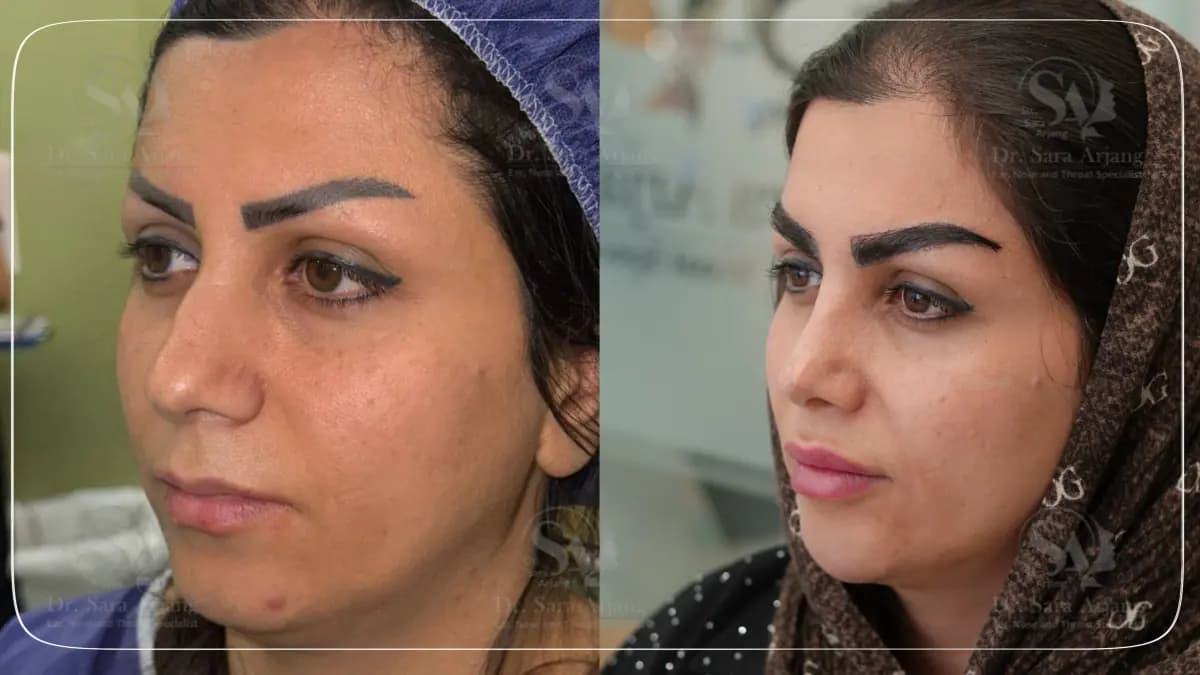 مريض لدى د. سارا أرجانج قبل عملية تجميل الأنف وبعدها، بزاوية ثلاثة أرباع.