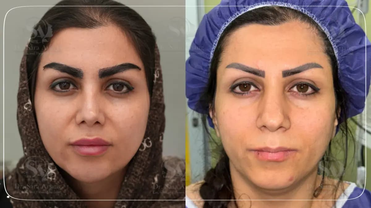 مريض لدى د. سارا أرجانج قبل عملية تجميل الأنف وبعدها، من الأمام.