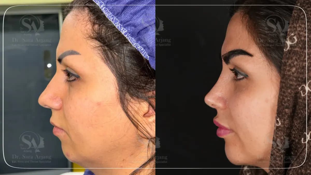 مريض لدى د. سارا أرجانج قبل عملية تجميل الأنف وبعدها، من الجانب.