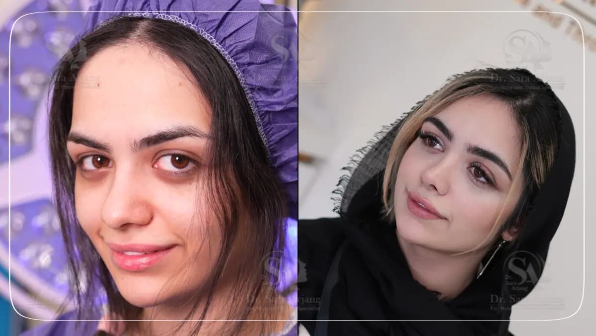 مريض لدى د. سارا أرجانج قبل عملية تجميل الأنف وبعدها، بزاوية ثلاثة أرباع.
