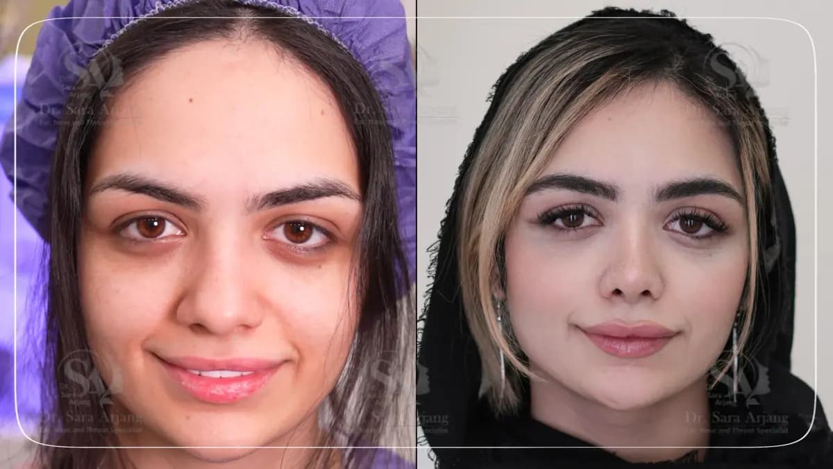 مريض لدى د. سارا أرجانج قبل عملية تجميل الأنف وبعدها، من الأمام.