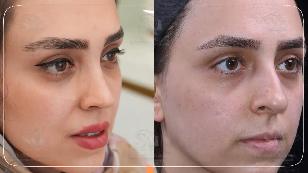 مريض لدى د. سارا أرجانج قبل عملية تجميل الأنف وبعدها، بزاوية ثلاثة أرباع.