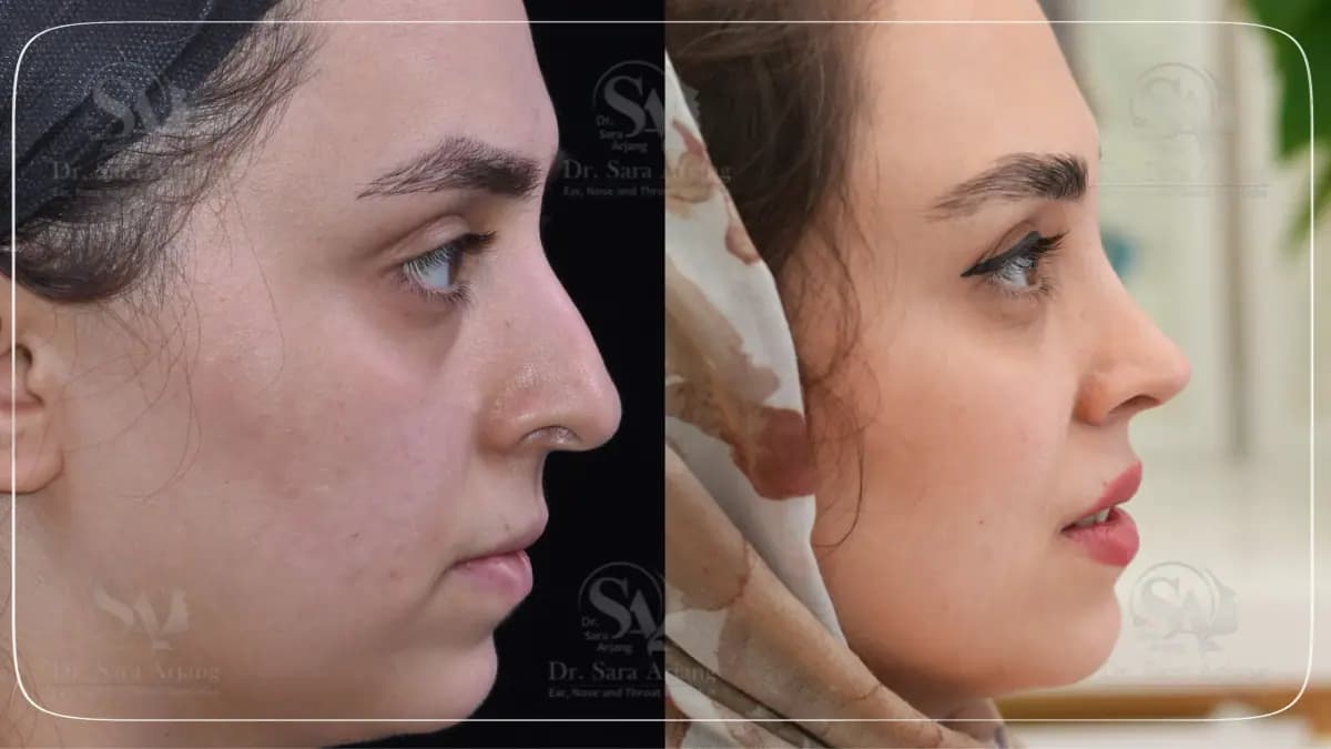 مريض لدى د. سارا أرجانج قبل عملية تجميل الأنف وبعدها، من الجانب.