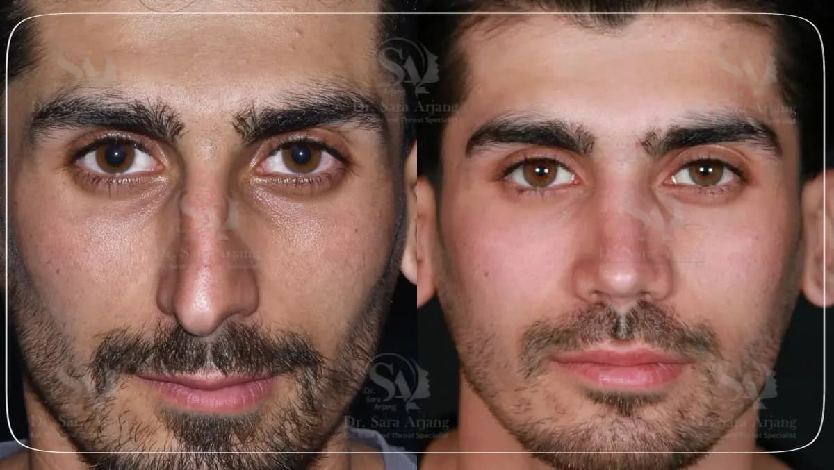 مريض لدى د. سارا أرجانج قبل عملية تجميل الأنف وبعدها، من الأمام.