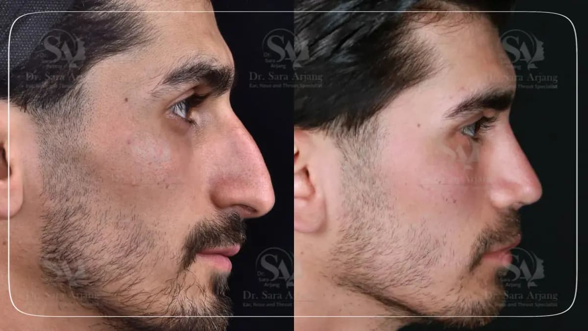 مريض لدى د. سارا أرجانج قبل عملية تجميل الأنف وبعدها، من الجانب.