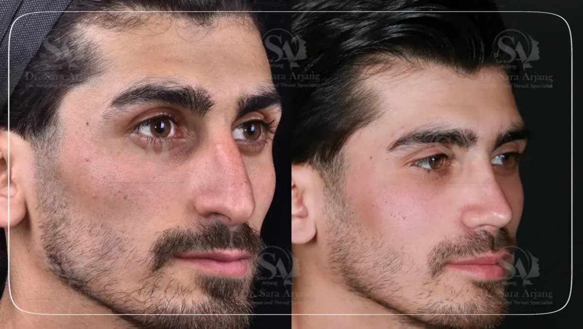 مريض لدى د. سارا أرجانج قبل عملية تجميل الأنف وبعدها، بزاوية ثلاثة أرباع.