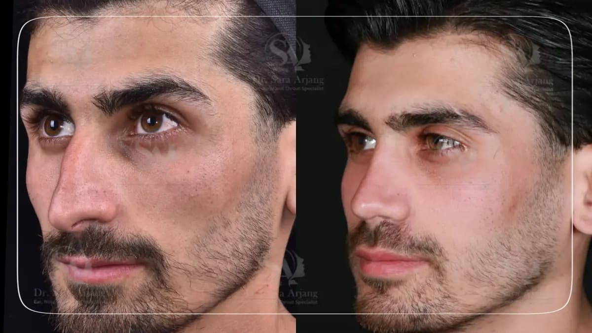 مريض لدى د. سارا أرجانج قبل عملية تجميل الأنف وبعدها، بزاوية ثلاثة أرباع.