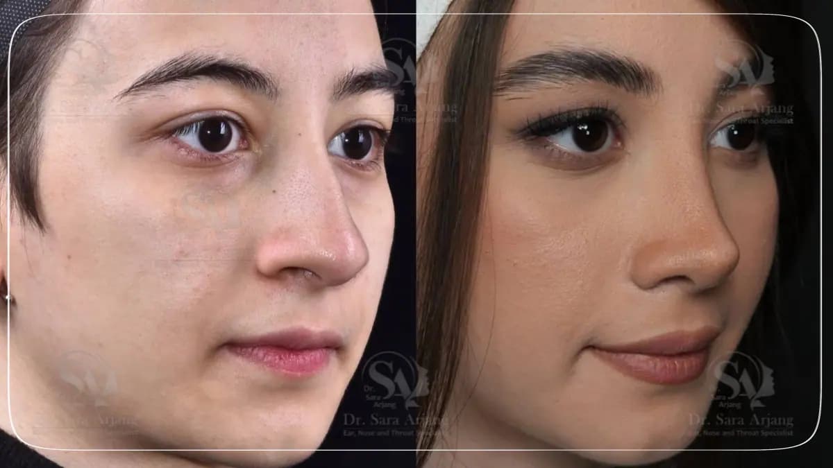 مريض لدى د. سارا أرجانج قبل عملية تجميل الأنف وبعدها، بزاوية ثلاثة أرباع.