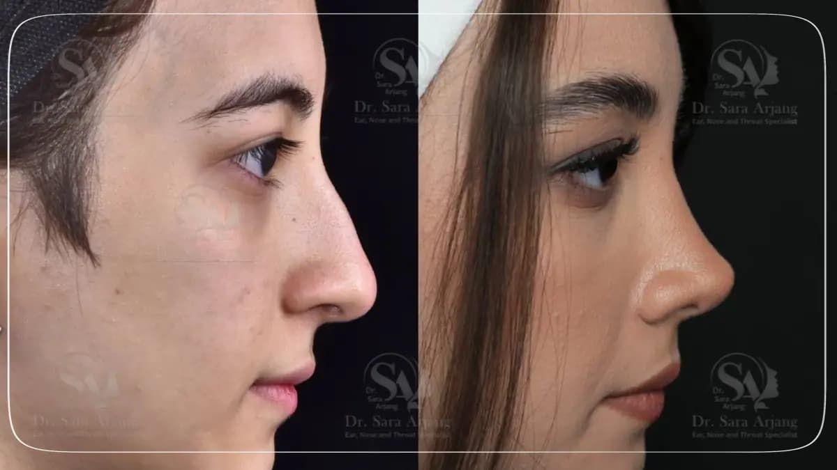 مريض لدى د. سارا أرجانج قبل عملية تجميل الأنف وبعدها، من الجانب.