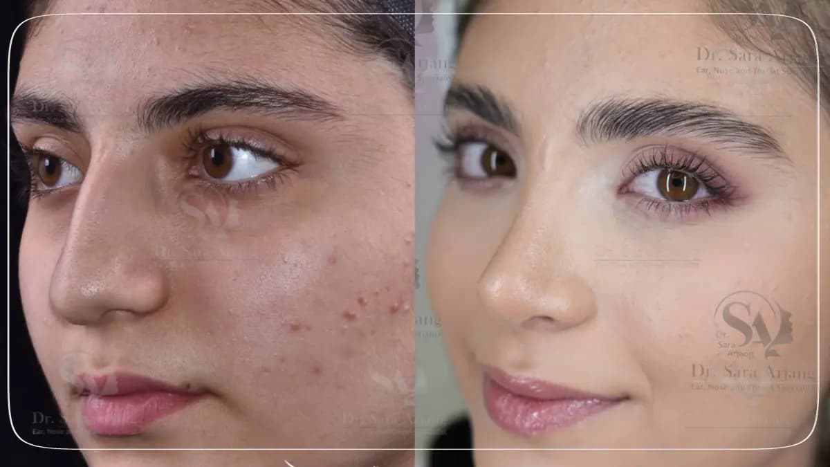 مريض لدى د. سارا أرجانج قبل عملية تجميل الأنف وبعدها، بزاوية ثلاثة أرباع.